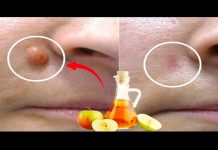 JABUČNI OCAT uklanja BRADAVICE za 24 SATA! Samo napravite ovo…