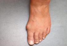 Šta znači ako vam se stopala preterano znoje? U ovom slučaju radi se o fatalnoj bolesti