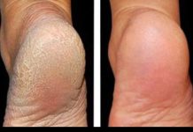 GENIJALAN RECEPT ZA GRUBE RUKE, ISPUCALE PETE, KURJE OČI I KRIVE NOKTE NA NOGAMA: