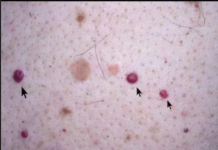 IMATE LI OVE CRVENE TAČKICE NA TIJELU? To nisu popucali kapilari, EVO O ČEMU SE ZAISTA RADI