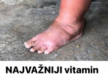 NAJVAŽNIJI vitamin za otklanjanje otoka ruku, nogu i stopala!