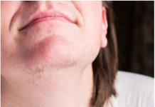 Jeste li se ikada zapitali o pojavi dlaka na bradi kod žena? Istražimo što vaše tijelo možda pokušava komunicirati.