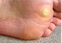 NARODNI LIJEK POZNAT OD DAVNINA – KURJE OKO ĆE NESTATI KAO RUKOM ODNEŠENO: Evo šta vam samo treba