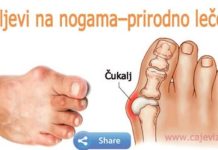 KAKO SE OSLOBODITI ČUKLJEVA NA NOGAMA