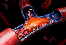 PLUĆNA EMBOLIJA JE VEĆI UZROK SMRTI OD INFARKTA! Dr Seferović otkriva: “Glavni simptom se vidi na nozi”