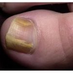 RIJEŠITE SE ŽUTIH I ZADEBLJALIH N0KTIJU UZ 0VAJ PREPARAT POGLEDAJTE SVE NA LINKU U KOMENTARU ⬇️⬇️⬇️