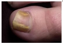 RIJEŠITE SE ŽUTIH I ZADEBLJALIH N0KTIJU UZ 0VAJ PREPARAT POGLEDAJTE SVE NA LINKU U KOMENTARU ⬇️⬇️⬇️