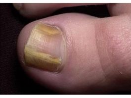 RIJEŠITE SE ŽUTIH I ZADEBLJALIH N0KTIJU UZ 0VAJ PREPARAT POGLEDAJTE SVE NA LINKU U KOMENTARU ⬇️⬇️⬇️