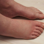 NAJVAŽNIJI vitamin za otklanjanje otoka ruku, nogu i stopala!