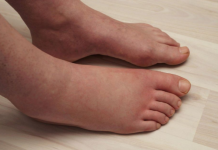 NAJVAŽNIJI vitamin za otklanjanje otoka ruku, nogu i stopala!