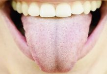 BIJELI PREMAZ NA JEZIKU? Nikada nemojte zanemariti ovaj simptom – 2 važna organa mogu biti oslabljena…