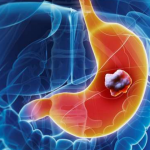 5 ranih simptoma raka želuca: Tumor može da raste godinama, a svi pacijenti prvo osjete ovo