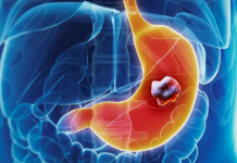 5 ranih simptoma raka želuca: Tumor može da raste godinama, a svi pacijenti prvo osjete ovo