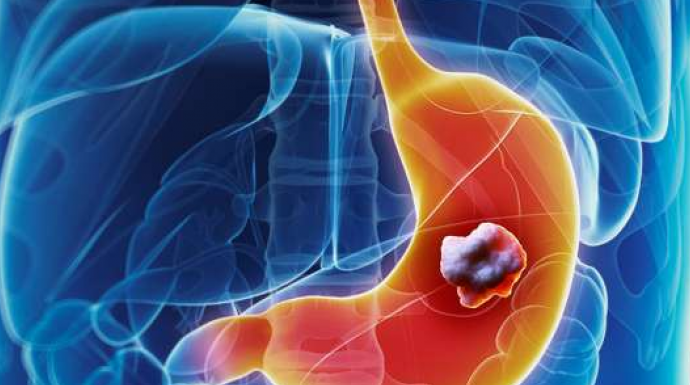 5 ranih simptoma raka želuca: Tumor može da raste godinama, a svi pacijenti prvo osjete ovo