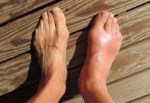 7 namirnica koje potiho stvaraju mokraćnu kiselinu i uništavaju vaše zglobove