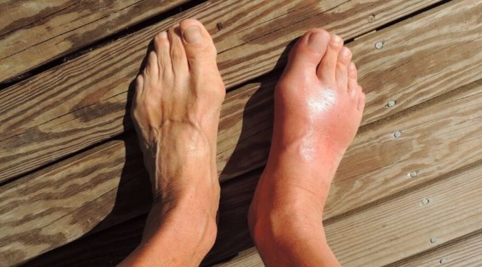 7 namirnica koje potiho stvaraju mokraćnu kiselinu i uništavaju vaše zglobove