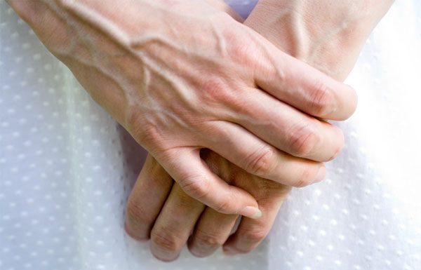 VENE SU VAM ISPUPČENE? 8 razloga zašto se to događa I KADA TREBATE POTRAŽITI DOKTORA!