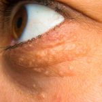 STAVILA SAM OVU NAMIRNICU NA MASNO TKIVO KOD OKA, ono je preko noći nestalo: EVO ŠTA ME SPASILO, SVI GA IMATE U KUĆI