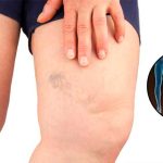 Simptomi krvnih ugrušaka u tijelu: Ako to primijetite, odmah potražite medicinsku pomoć