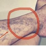 Svako ima ovaj lijek za ispucale kapilare kod kuće, ali mnogi ljudi ne znaju za njega!