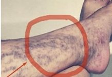 Svako ima ovaj lijek za ispucale kapilare kod kuće, ali mnogi ljudi ne znaju za njega!