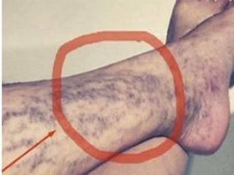 Svako ima ovaj lijek za ispucale kapilare kod kuće, ali mnogi ljudi ne znaju za njega!