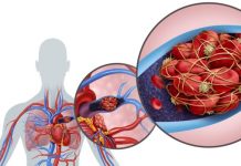 PLUĆNA EMBOLIJA JE VEĆI UZROK SMRTI OD INFARKTA! Dr Seferović otkriva: “Glavni simptom se vidi na nozi”