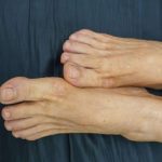 Visok holesterol možete prepoznati ako se zagledate u svoje noge: Ako primijetite ovo – imate ozbiljan problem