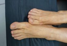 Visok holesterol možete prepoznati ako se zagledate u svoje noge: Ako primijetite ovo – imate ozbiljan problem