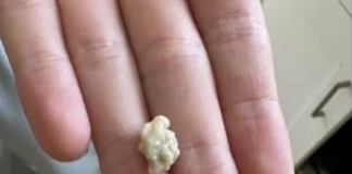 “Neočekivano i šokantno iskustvo: Ono što je izašlo iz mog grla će vas ostaviti bez riječi 😳”