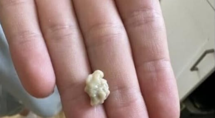 “Neočekivano i šokantno iskustvo: Ono što je izašlo iz mog grla će vas ostaviti bez riječi 😳”