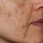 Evo kako da sa ovim jednostavnim trikom od 2 sastojka izbrišete mrlje s kože!