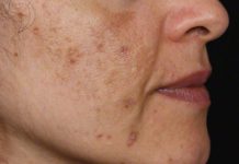 Evo kako da sa ovim jednostavnim trikom od 2 sastojka izbrišete mrlje s kože!