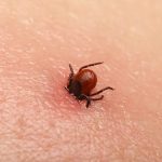Bezbolno je i nema čupanja: Doktorka otkrila trik kako da se krpelj sam otkači sa kože (video)