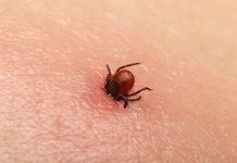 Bezbolno je i nema čupanja: Doktorka otkrila trik kako da se krpelj sam otkači sa kože (video)