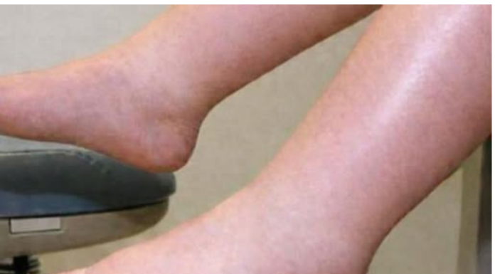 DA IZBACITE VIŠAK VODE POTREBAN VAM JE JEDAN VITAMIN: Ni noge vam više neće oticati, samo ga ubacite u ishranu